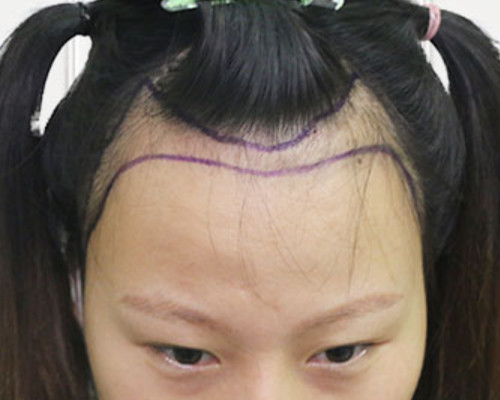 在杭州華山連天美治療我的發際線后移術后恢復效果分享